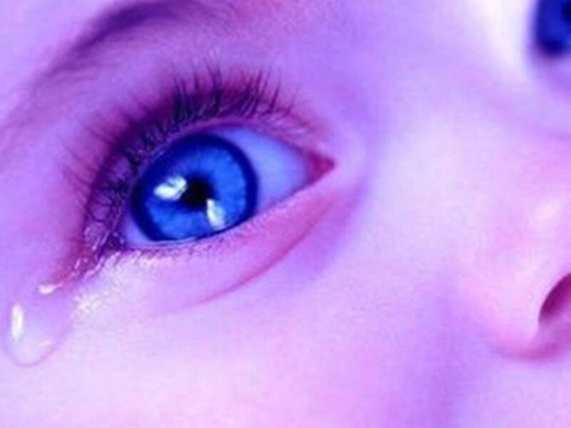 У младенцев с врожденной катарактой контактные линзы дают меньше осложнений чем ИОЛ 