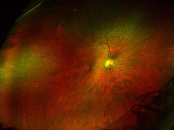 Сосуды глаз и почек позволяют диагностировать аритмию