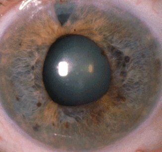 Диагностика и методы лечения катаракты