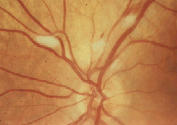 Ишемическая нейропатия зрительного нерва