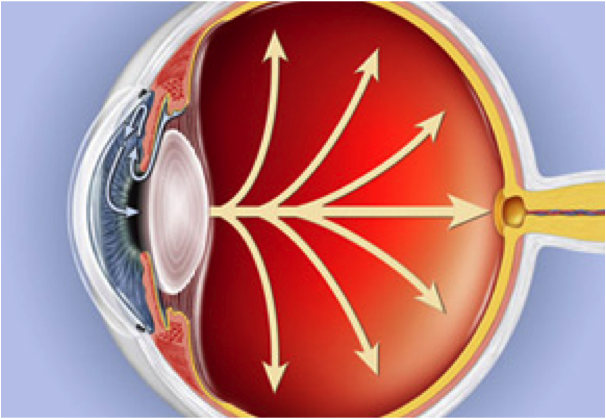 Фолаты эффективны при эксфолиативной глаукоме