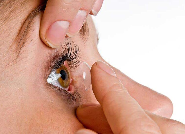 Мягкие контактные линзы дают хорошие результаты у пациентов с кератоконусом