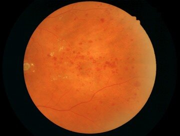 Кровоизлияния при пролиферативной диабетической ретинопатии.jpg