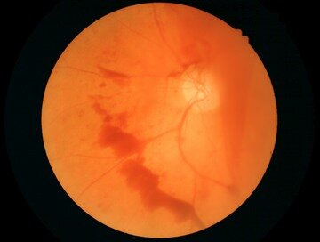 Тяжелая пролиферативная диабетическая ретинопатия. Кровоизлияние в стекловидное тело из новообразованных сосудов диска зрительного нерва.jpg