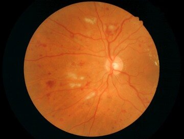 Ишемические фокусы и кровоизлияния при препролиферативной диабетической ретинопатии.jpg