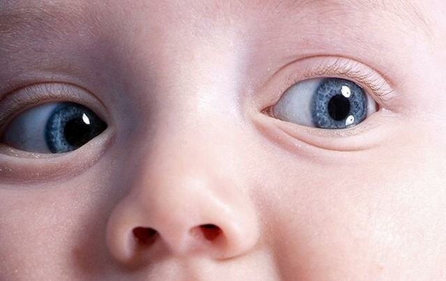 Слепота обоих глаз у младенца – обследование, лечение