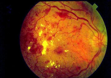 Тяжелая диабетическая пролиферативная ретинопатия.jpg